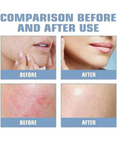Gla-Mory Micro-Infusion System for Lips Gla-Mory Micro System for Face Hyaluronic Acid Serum Gla-Moryfacial System with Hydrating Serum Smooth Face Serum for Women Skincare Anti Aging Serum for Face - Buy Online on GoSupps.com