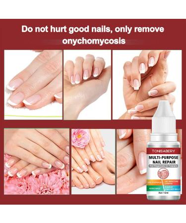 Fungal Nail Treatment Nail Fungus Treatment for Toenail Ingrown Toenail Treatment Toe Nail Fungal Treatment Fungal Nail Treatment for Toenails Extra Strong Nail Repair Treatment Repairing Broken Nail - Buy Online on GoSupps.com