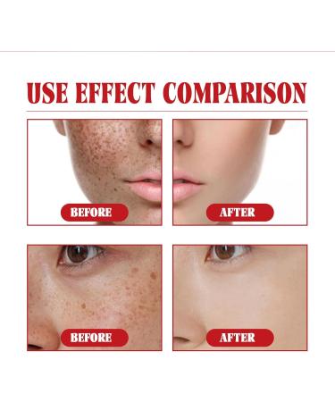 Melasma Treatment for Face Removes Facial Melasma Dark Spots Spot Cream Hyperpigmentation Treatment Sun Spots and Melasma Freckle Remover Remove Dark Spots Pigmentation Removal Cream for Face - Buy Online on GoSupps.com