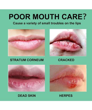 Mouth Ulcer Treatment Spray 30ml Mouth Ulcer Spray OralCare Propolis Ulcer Relief Spray for Wound Protection & Relief Canker Sore Treatment Herbal Mouth Spray Breath Spray for Bad Breath (2Pcs) - Buy Online on GoSupps.com