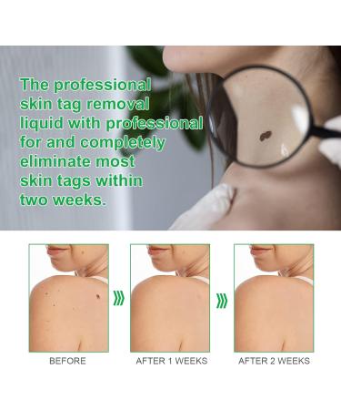 Skin Tag & Wart Remover Cream - Advanced Treatment Formula, Natural Ingredients - 20g - Buy Online on GoSupps.com
