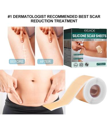 Teksome Silicone Scar Sheets - Stretch Mark Remover | Soften & Flatten Scars | For Surgery Injury Burns C-Section | 1.57*59 Inches - Buy Online on GoSupps.com