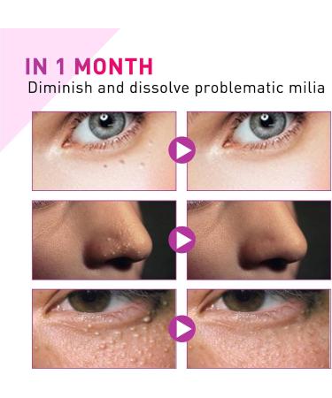 Milia Removal Face Serums Milia Spot Remover Milia Remover Milia Spot Serum for Face Milia Serum for Face Milia Spot Serum Helps to Ruduce Milia Reduces Bags Saggy Skin & Puffy Eyes 30ML - Buy Online on GoSupps.com