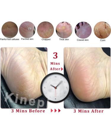 Kinepi Callus Remover Foot Scrubber - Exfoliating Foot File and Pedicure Tool for Smooth, Soft Feet - Pumice Stone for Shower Use - Foot Scraper Kit - Buy Online on GoSupps.com