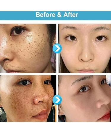 REATIFUL Concentrated Skin Removal Cream - Herbal Formula Ointment for Skin Cleanup (1 set) - Buy Online on GoSupps.com