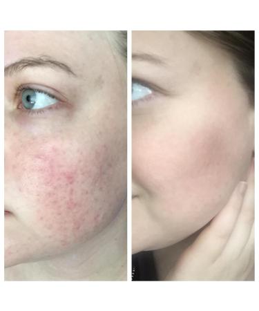 Organic Essential Oils for Rosacea Relief - 28-Day Dual Stage Treatment - Buy Online on GoSupps.com