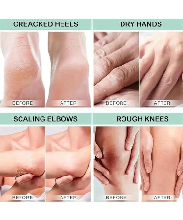 Urea Foot Cream Urea 42% Foot Cream Foot Moisturiser Feet Cream For Dry Cracked Skin Hard Skin Remover Heel Cream 42% Urea Cream & 2% Salicylic Acid Dry Feet Cream Cracked Heel Repair Cream Foot Balm - Buy Online on GoSupps.com