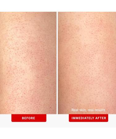 First Aid Beauty - KP Bump Eraser Body Scrub with 10% AHA Keratosis Pilaris Skin Exfoliator with Glycolic & Lactic acids Helps Reduce Chicken Skin Bumps Safe for Sensitive Skin 2 oz 3 ct 2 Ounce (Pack of 3) - Buy Online on GoSupps.com