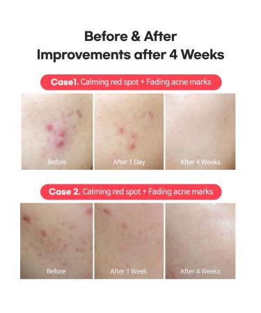 TIAM AC Fighting Spot RX Cream - Best Acne Treatment for Acne-Prone Skin Nourishing & Calming Relief for Red Skin - 1 Oz - Buy Online on GoSupps.com