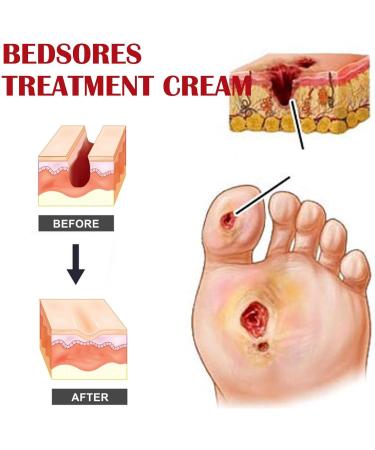 Bedsore Wound Care Cream 20g Fast Healing For Wound Healing Soress Relief Healing Cream Relief Chafed Skin Hard To Heal Skin Soress Soothing Relief Of Bed Soress Pressure Soress Relief Cream - Buy Online on GoSupps.com