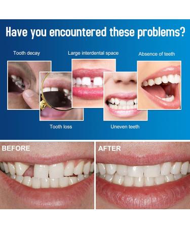 Allony Tooth Repair Set - Fix Broken Teeth DIY Dentures & Moldable False Teeth with Dental Adhesive - Buy Online on GoSupps.com