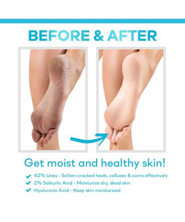 Ellocy 42% Urea Gel with Salicylic & Hyaluronic Acid - Cracked Heel Repair & Toenail Fungus Treatment - Buy Online on GoSupps.com