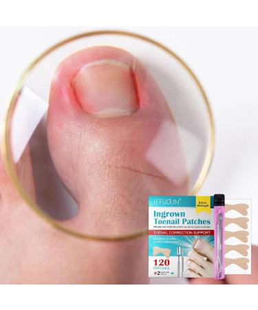 Ingrown Toenail Patch Ingrown Toenail Corrector | Toenail Repair to Relieve Nail Groove Nail Correction Patches Suitable for Men Women and Elderly Adern - Buy Online on GoSupps.com