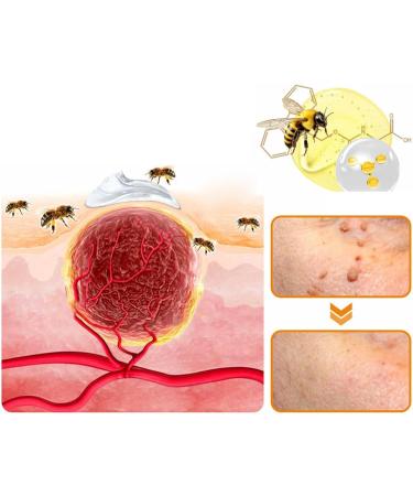 Ximonth Bee Venom Wart Repair Cream - Professional Moisturizer for All Skin Types - 2pcs for Men & Women - Buy Online on GoSupps.com