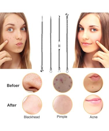 Blackhead Removal Tools 4 Pcs Professional Stainless Pimple Popper Kit with Portable Case - Buy Online on GoSupps.com