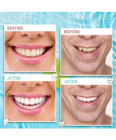 High-Quality False Teeth Veneers | White Dentures for Top & Lower Jaw | Smile Restoration - 5 Piece Set - Buy Online on GoSupps.com