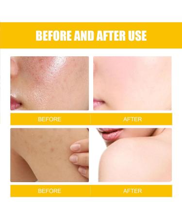 KOAHDE Facial Anti Acne Essence Acne Essence Anti Acne Hydrating Essence Anti Acne Facial Serum Acne Treatment Serum Serum Skin Smoother Acne Removing Moisturizing Serum Skin Rejuvenation Serum - Buy Online on GoSupps.com