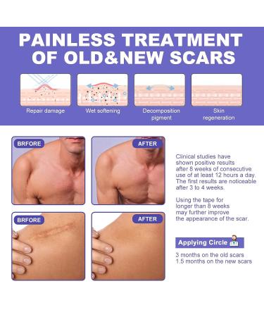 OK TAPE Silicone Scar Tape - Reusable Silicone Strips for Scar Removal (1.5 x 3.3 yards) | Burns, Surgery, Acne, Keloid, Injury - Buy Online on GoSupps.com