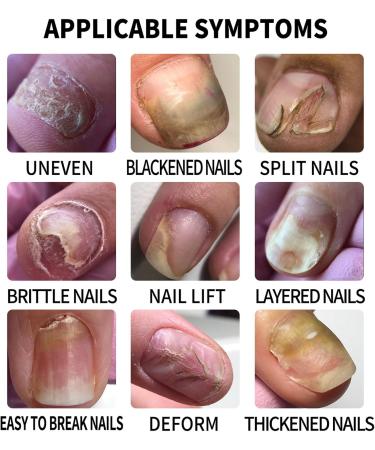 Nail Repair Treatment | Stick Applicator for Brittle Toenails Nourishing Fortifier for Manicures at Home or in Salons 10 ml - Buy Online on GoSupps.com
