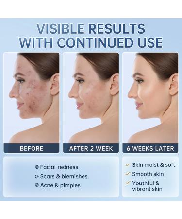 HGTG 14% Azelaic Acid Acne Cream - Azelaic Acid Serum with Hyaluronic Acid Niacinamide & Squalane - Reduce Acne Pore Refining & Oil Control - Buy Online on GoSupps.com
