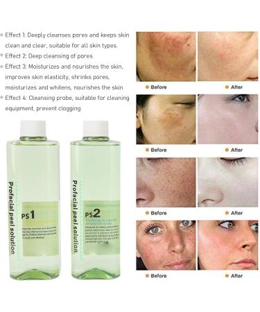 Hydra Dermabrasion Solution Moisturizing 4 Piece Peeling Hydro Solution Skin Tightening for Salon - Buy Online on GoSupps.com