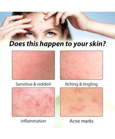 20% Azelaic Acid Serum Cream Azelaic Acid Cream Face Serum Skin Care Beauty with Niacinamide & Vitamin C Reduces Blackheads Acne Rosacea - Buy Online on GoSupps.com
