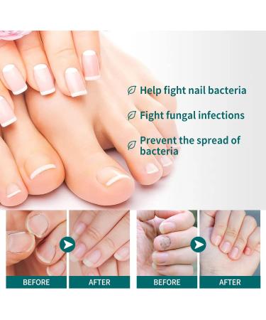 Anti-Fungal Nail Treatment Kit with Nail Clippers & Glass Nail File - Natural Ingrown Toenail Correction & Fungal Nail Repair - 2 in 1 Nail Care Solution - Buy Online on GoSupps.com