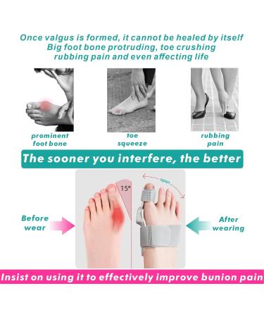 Ashomie Bunion Corrector Toe Separator for Men & Women - Pain Relief Brace (Blue 1PC) - Buy Online on GoSupps.com