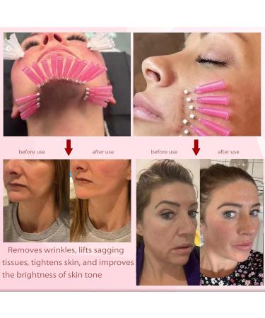 Minovd PDO Mono Threads 29g - 38mm 40 Pieces for Facial Lift | Improve Skin Structure & Reduce Fine Lines - Buy Online on GoSupps.com