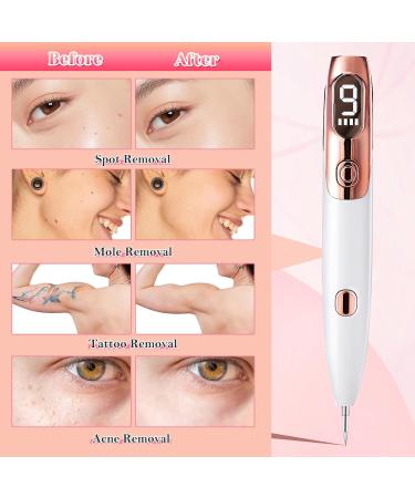 Skin Tag Removal Pen Weslery Skin Tag Remover Pen Laser's Pen with 9 Strength Levels & LED Light Mole Remover Pen USB Rechargeable Spot Pen Plasma Pen for Face Body Wart Freckle Nevus Spot Age Spots - Buy Online on GoSupps.com