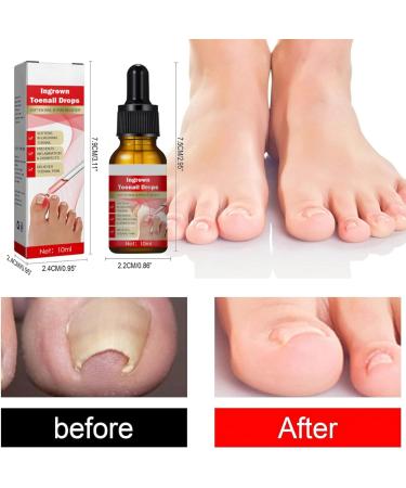 Ingrown Toenail Treatment Nail Growth Ingrowing Toenail Treatment Nail Helper Fungal Nail Treatment Correction Oil Drops Ingrown Toenail Corrector Toe Nail Fungus Treatment Cuticle Oil - Buy Online on GoSupps.com