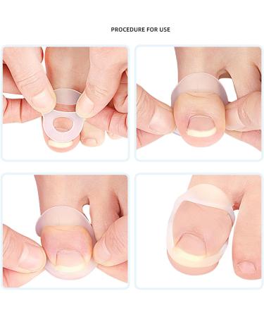 10PCS Silicone Ingrown Toenail Corrector Ingrown Toenail Corrector Set Nail Corrector Ring Silicone Ingrown Toenail Correcting Tool Washable Reusable Paronychia for Keep Nail He - Buy Online on GoSupps.com