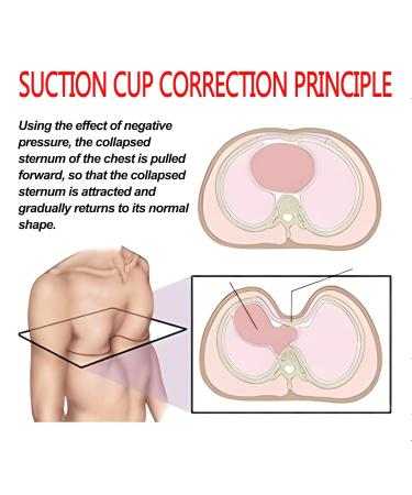 Pectus Excavatum Orthosis Brace-Vacuum Bell Pectus Excavatum-Sternal Depression Support-for All Ages(L) - Buy Online on GoSupps.com