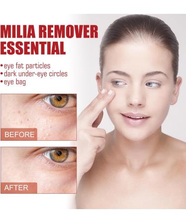 Milia S rum d maquillant pour le contour des yeux S rum facial contre les miliums et les taches brunes pour homme et femme r duit le rel chement de la peau les gonflements et les ridules 30 ml 1 pi ce. - Buy Online on GoSupps.com