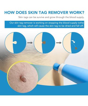 Skin Tag Remover Kit for Face & Body - Fast & Easy Removal Pen for 2mm-8mm Tags, Safe & Painless with 40 Bands & 10 Wipes - Buy Online on GoSupps.com