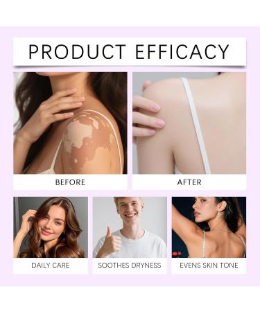 Boxiatil Vitiligo Cream 2pcs Intensive Treatment for White Spots & Repigmentation | Treatment for White Spots on Skin Reduces Leukoplakia | Brightening Treatment for Vitiligo - Buy Online on GoSupps.com
