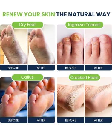 Tea Tree Foot Soak Callus Remover Gel - Extra Strength Callus Remover Gel & Foot Soak With Epsom Salts For Calluses Dry Cracked Heels Toenail Fungus & Odor - Pedicure for Tired Feet - Buy Online on GoSupps.com