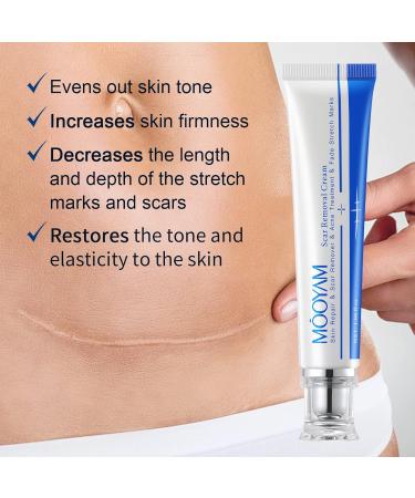 Scar Removal Cream - Rapid Repair for Acne, Surgery, Injury & Burns - 30g - Buy Online on GoSupps.com