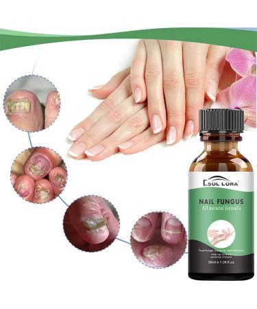 Fungal Nail Treatment - Extra Strong Nail Fungus Treatment for Toenail and Fingernail - Anti fungus Nail Repair and Strengthen Fix & Renew Damaged Broken Nails Restoring Healthy Nails-30ml - Buy Online on GoSupps.com