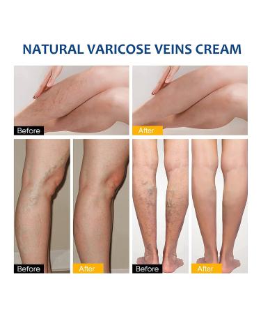 TASVAM Varicose Veins Cream - Treatment for Legs, Relief Spider Veins, Strengthen Capillaries for Improved Circulation - Buy Online on GoSupps.com