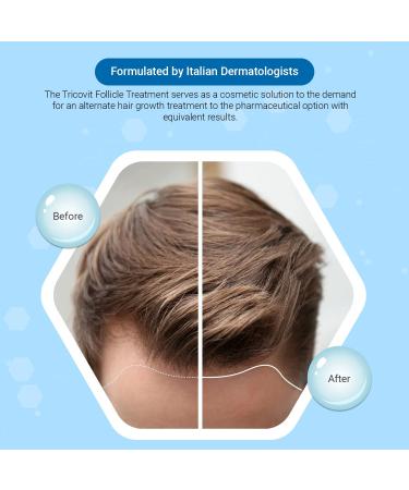 Tricovit Forte Hair Lotion - Hair Growth Serum with DHT Blockers - Promotes Stronger Thicker Hair - 5 Ampoules, 1.36 Fl Oz (Pack of 5) - Buy Online on GoSupps.com