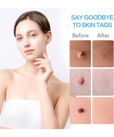 2-IN-1 Micro Skin Tag Tool Kit Quick and Painless Solution for Medium to Large Skin Tags (2mm-7mm) Complete Skin Tag Tool Kit for Fast Results - Buy Online on GoSupps.com