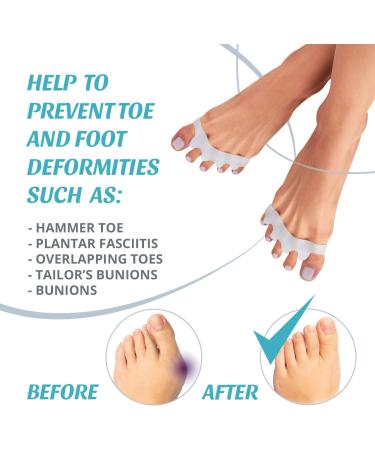 Silicone Toe Separators for Overlapping Toes | Bunion Corrector and Toe Spacers for Hammer Toe | Toe Straighteners for Crooked Toes | 2 pcs Set (White) - for Women and Men - Buy Online on GoSupps.com