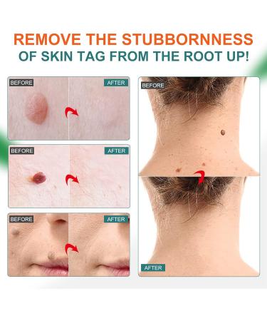 Skin-Tag-Remover Kit Remover for Verruca-Treatment - 30ml - Buy Online on GoSupps.com