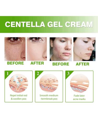 Centella Calming Gel Cream Centella Face Serum for Women Centella Moisturiser Face Moisturiser for Acne Prone Skin Hydrating Face Moisturizer for Women with Tea Tree Oil Centella Repair Face Cream - Buy Online on GoSupps.com