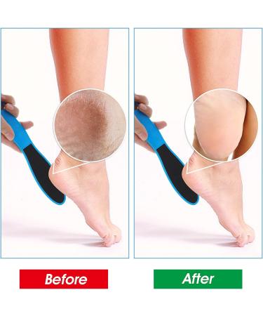 Wllhyf 4-Piece Double-Sided Pedicure Tool Set - Reusable Foot Scrubber for Dead Skin Remover Foot Care for Wet Dry & Cracked Feet - Buy Online on GoSupps.com