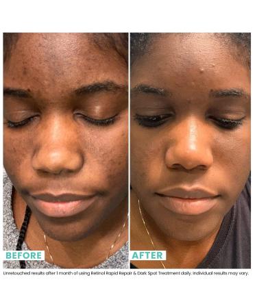 Urban Skin Rx Retinol Rapid Repair & Dark Spot Treatment | Niacinamide Formula for Hyperpigmentation, Fine Lines, Blemishes | 1.0 Fl Oz - Buy Online on GoSupps.com