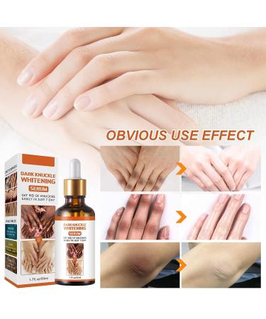 Dark Knuckle Whitening Serum 1.7 Fl Oz - Repair Melanin, Lighten Skin & Remove Darkening - Body Bleaching for Knuckle Elbows - Buy Online on GoSupps.com