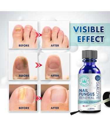 Toenail Fungus Treatment Extra Strength: Fungus Nail Treatment Fast Acting - Nail Fungal Treatment for Toenail and Fingernail - Nail Fungus Treatment for Men & Women - 30ML - Buy Online on GoSupps.com