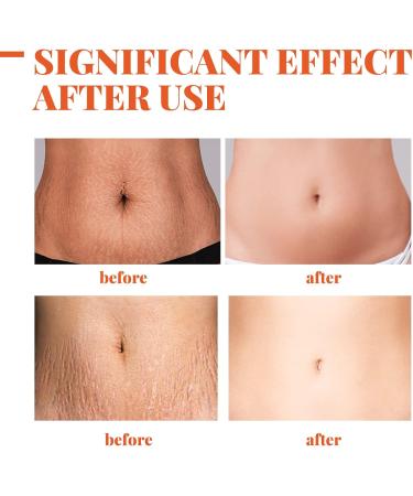 Stretch Mark Repair Essential Oil - 2/3/4PCS Pregnancy & Postpartum Scar Treatment | Prevent & Remove Stretch Marks - Buy Online on GoSupps.com